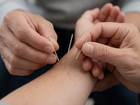Mains du thérapeute insérant des aiguilles d'acupuncture sur l'avant-bras du patient en gros plan avec un fond flou.
